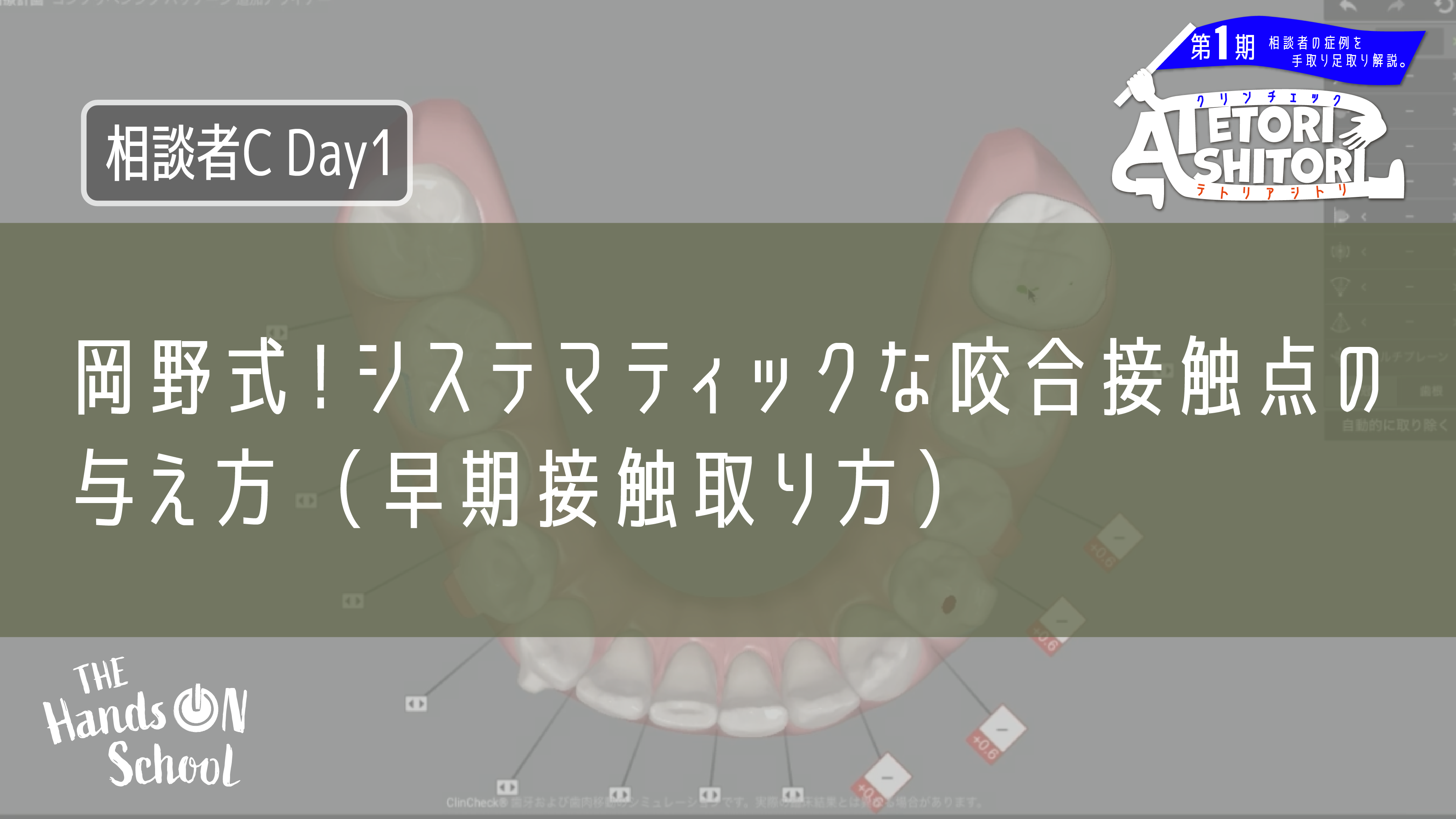 岡野式!システマティックな咬合接触点の与え方(早期接触取り方)|相談者C DAY1