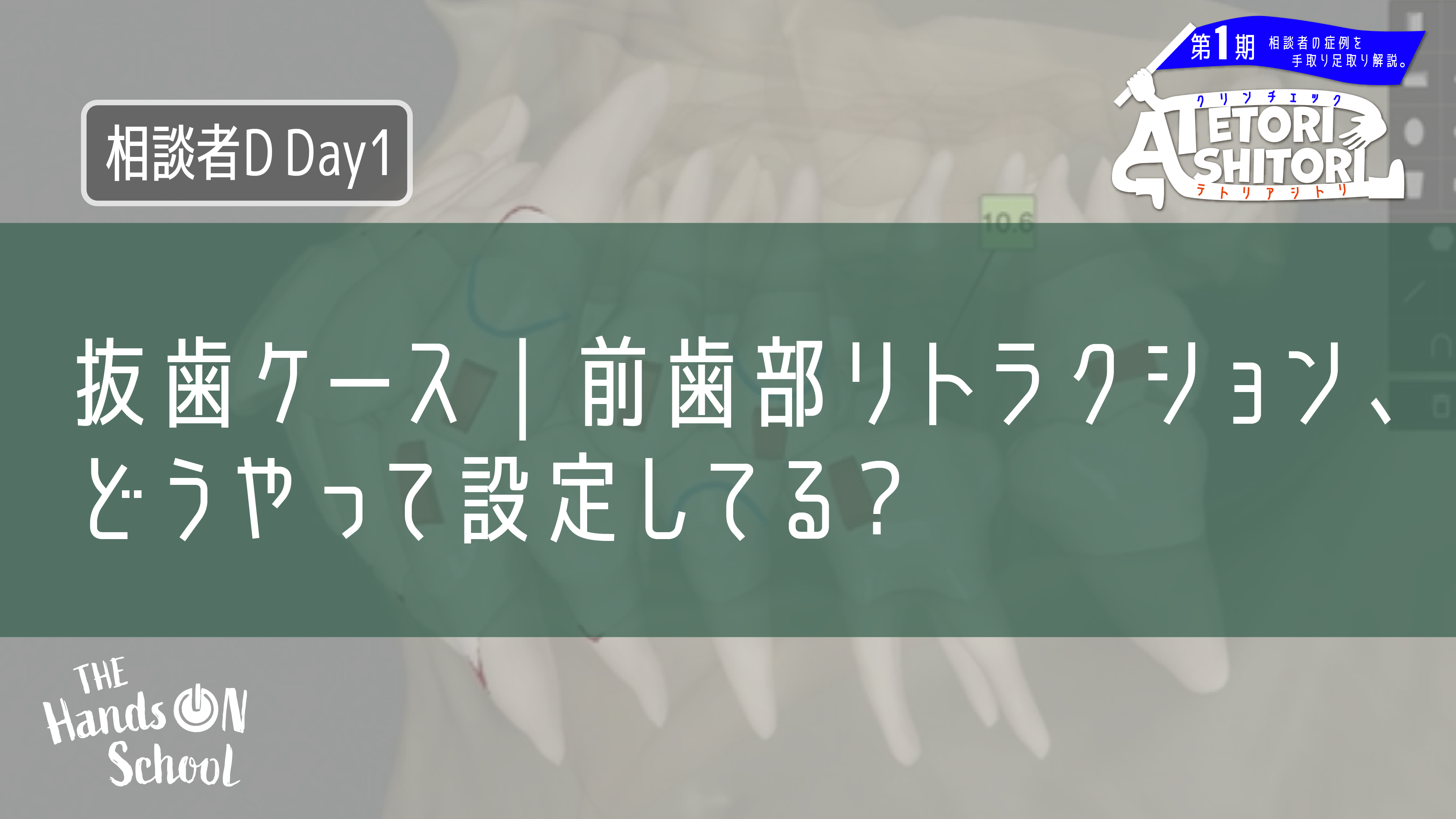 抜歯ケース|前歯部リトラクション、どうやって設定してる?|相談者D DAY1