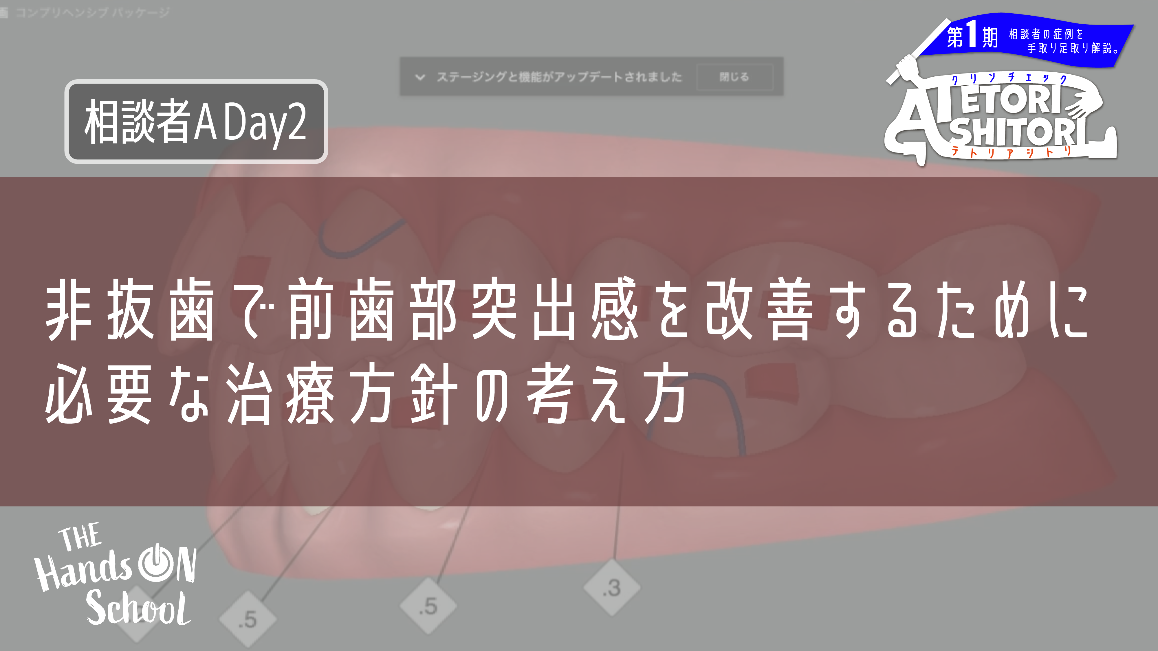 非抜歯で前歯部突出感を改善するために必要な治療方針の考え方|相談者A DAY2