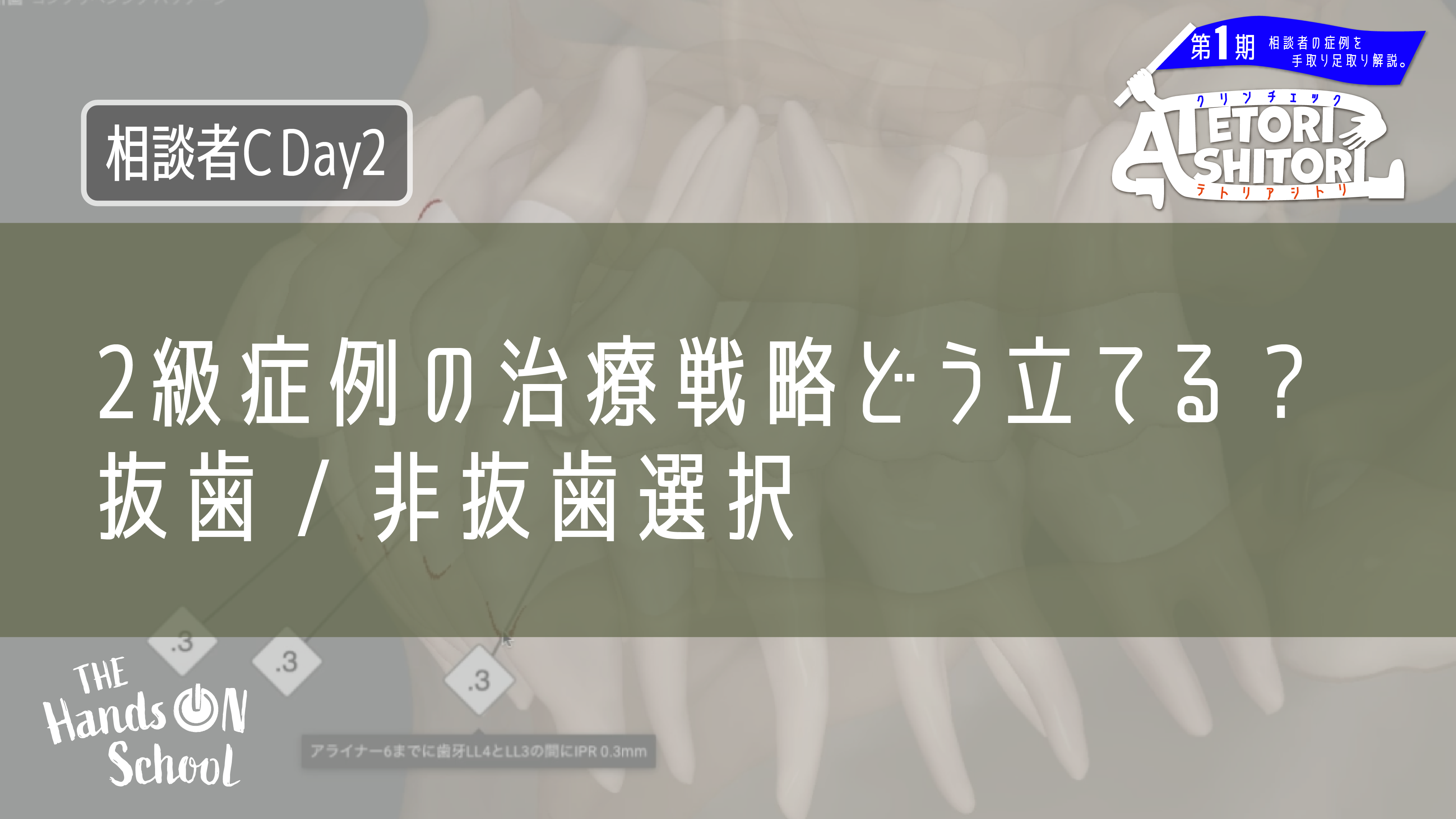 2級症例の治療戦略どう立てる?抜歯/非抜歯選択|相談者C DAY2