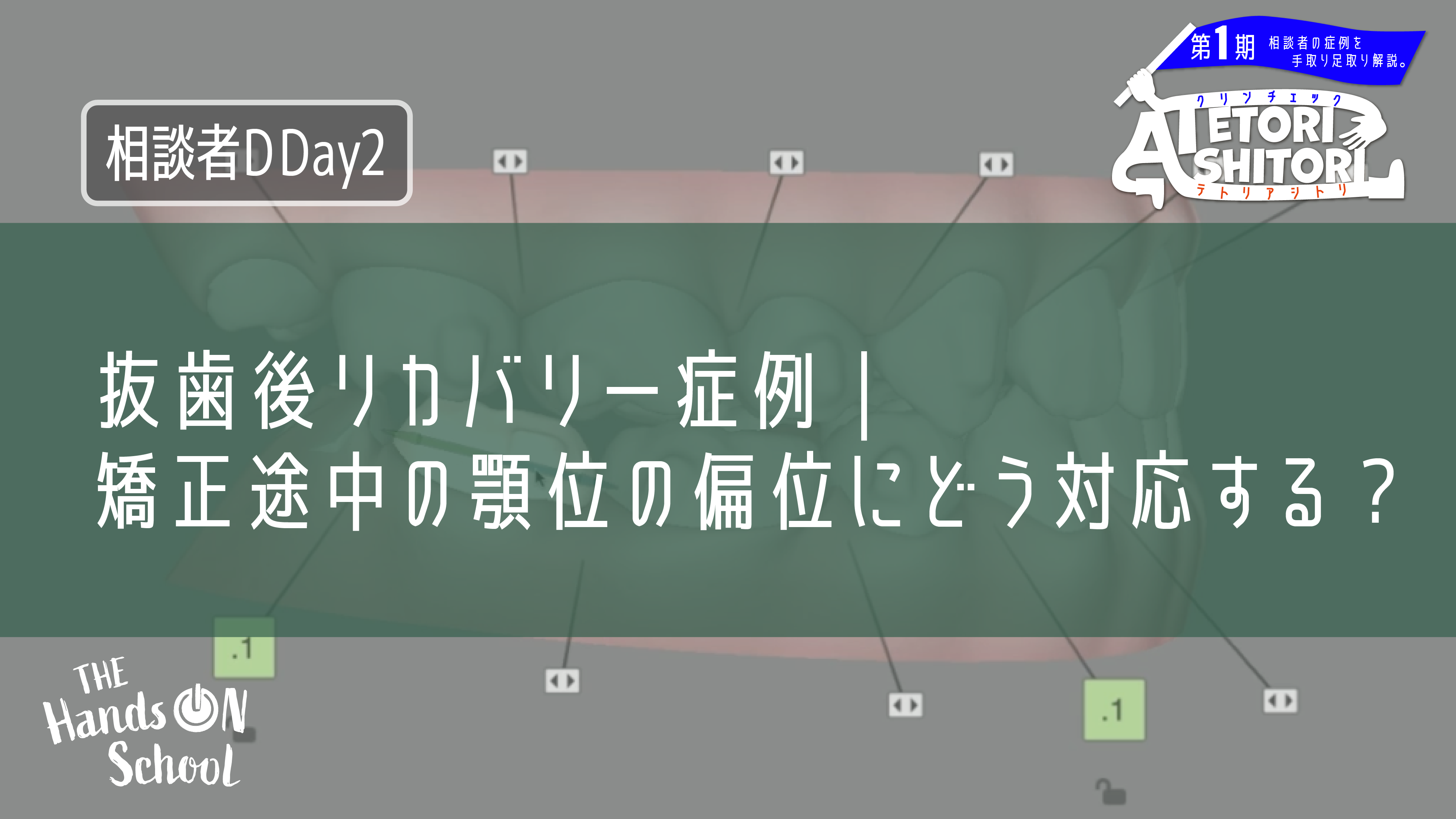 抜歯後リカバリー症例|矯正途中の顎位の偏位にどう対応する?|相談者D DAY2