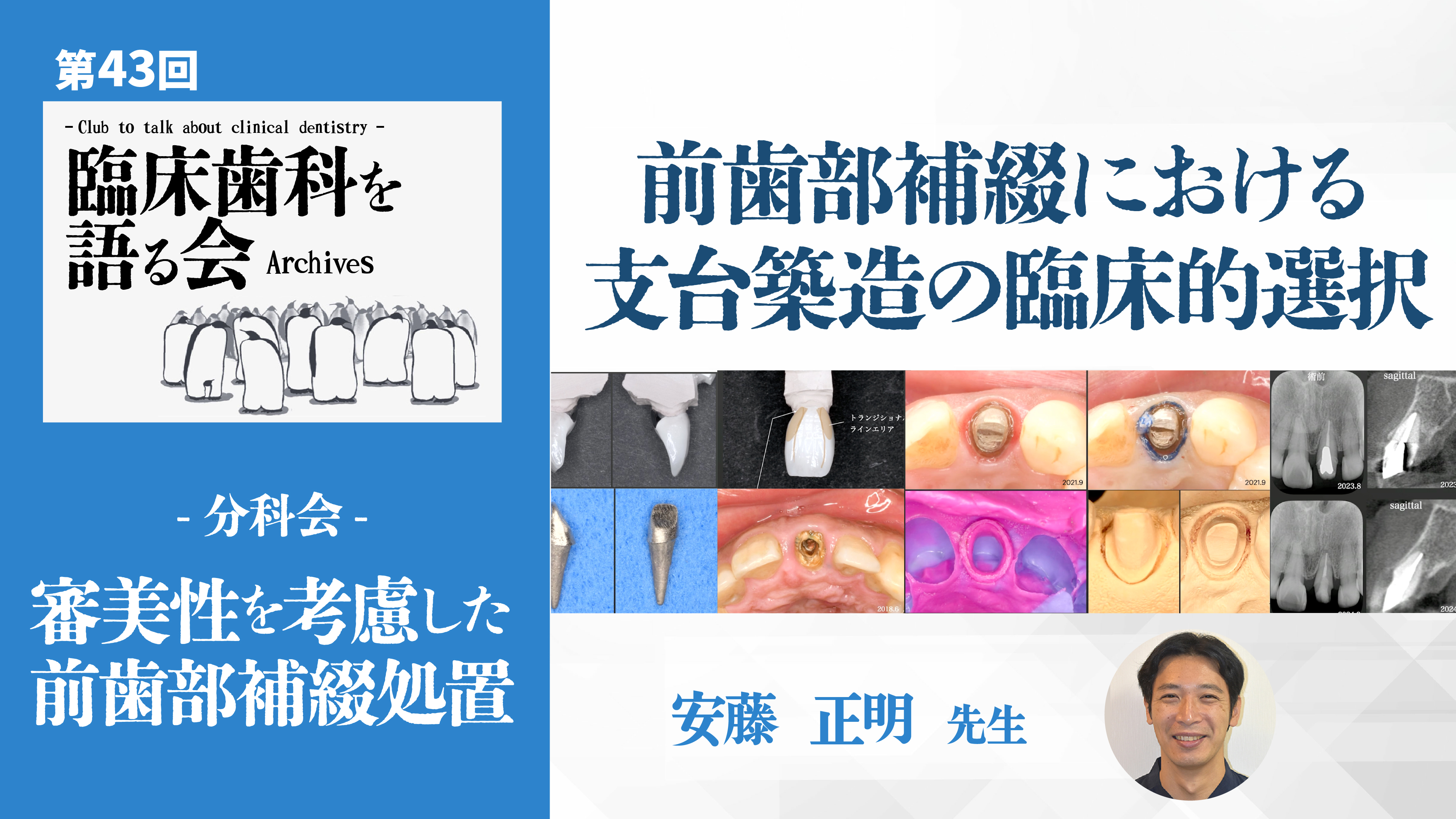 前歯部補綴における支台築造の臨床的選択|第43回 臨床歯科を語る会 分科会【審美性を考慮した前歯部補綴処置】【05/22-05/28 プレミアム化】