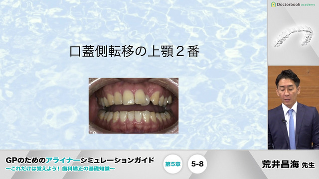 第5章 症例ごとの治療計画│GPのためのアライナー 第5章 症例ごとの治療計画│GPのためのアライナー