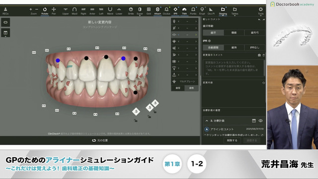 第1章 クリンチェックの特徴│GPのためのアライナーシミュレーション