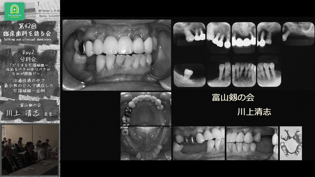 どうする欠損補綴 ~攻めるべきか待つべきか,それが問題だ~|第 どうする欠損補綴 ~攻めるべきか待つべきか,それが問題だ~|第