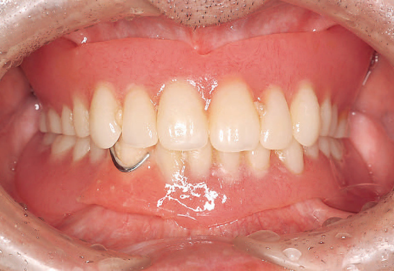バウチャー 無歯顎患者の補綴治療 原著第12版 2008年3版1刷 送料520円 【a-3693】 - 健康と医学