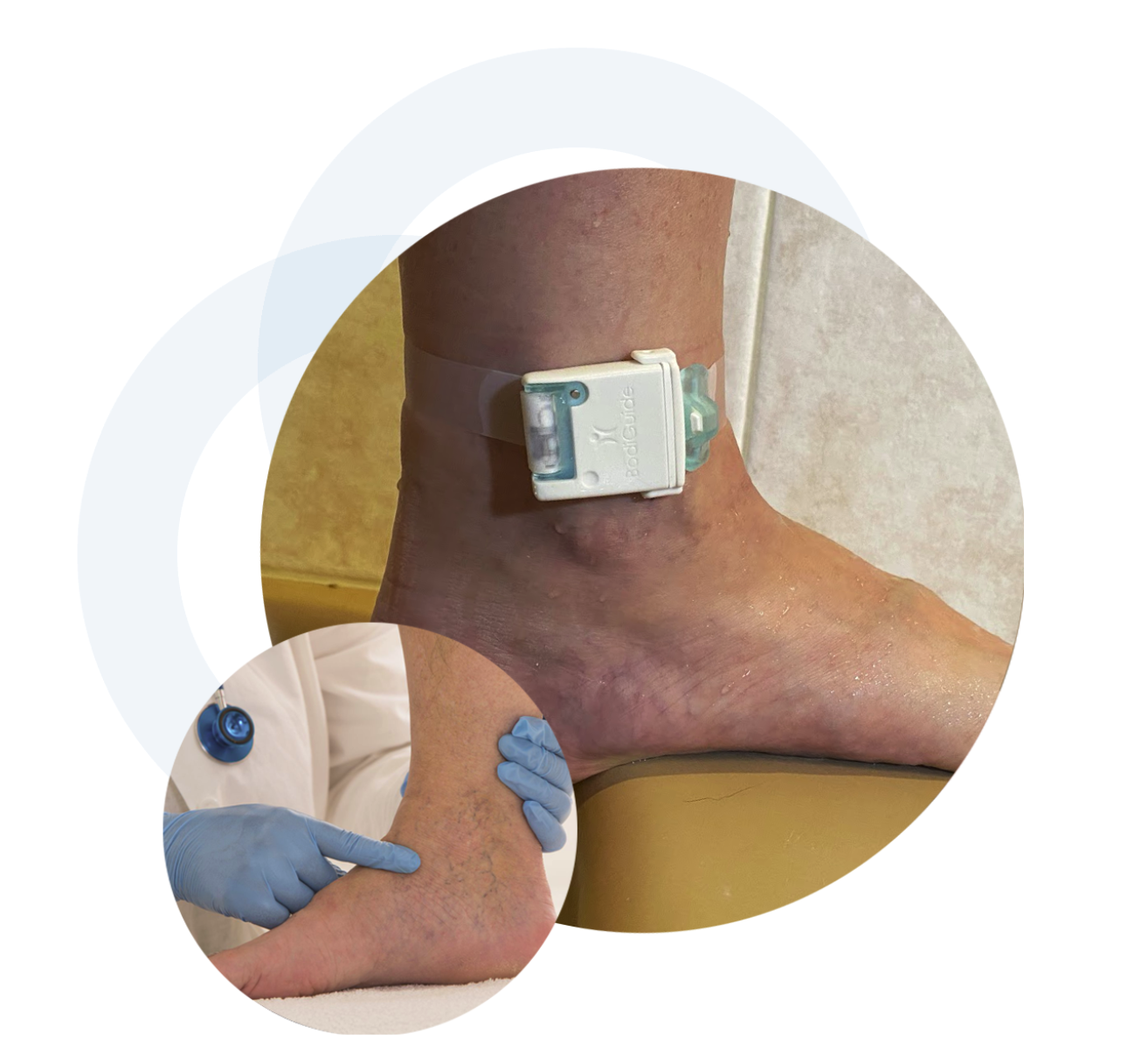 BodiGuide's Wearable Fluid-Retention Measuring System Solves the 'Ineffective Monitoring' Problem: Reduces Heart-Failure Hospitalization