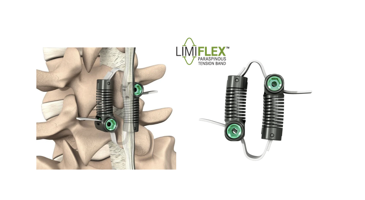 FDA Grants PMA Approval to LimiFlex(TM) Dynamic Sagittal Tether