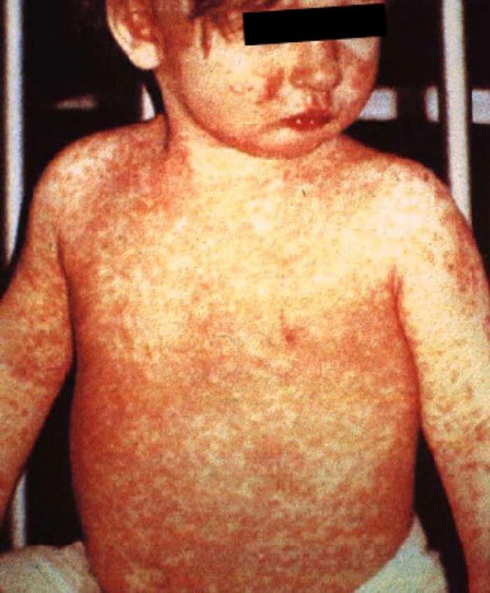Measles Rare Pediatric Disease Drug Designation Application Filed for NV-387, PRV Provides for Strong Business Case, Says NanoViricides