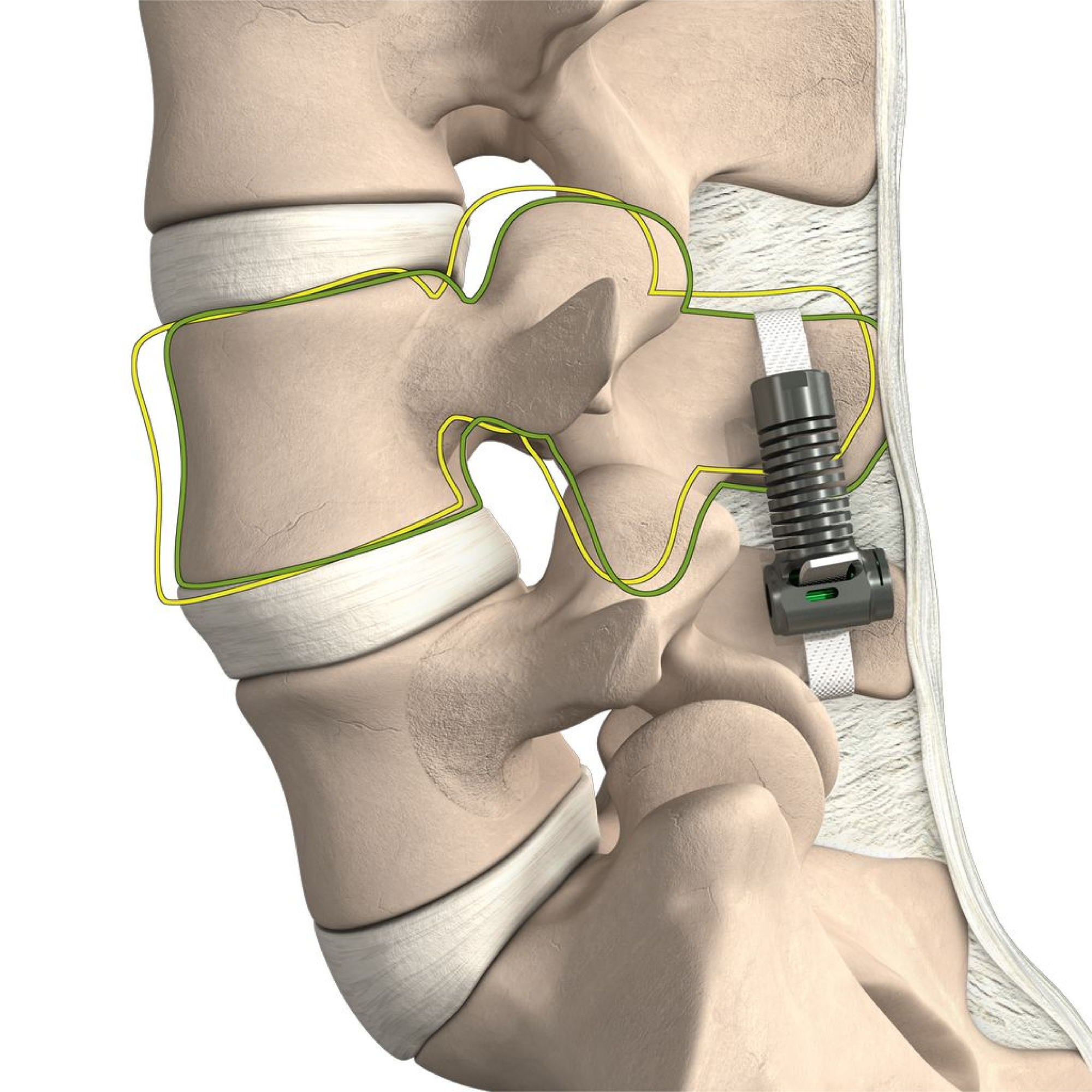 Empirical Spine Announces First Commercial LimiFlex(R) Cases at Stanford Medicine, Marking U.S. Launch of Motion-Preserving Alternative to Fusion for Degenerative Spondylolisthesis