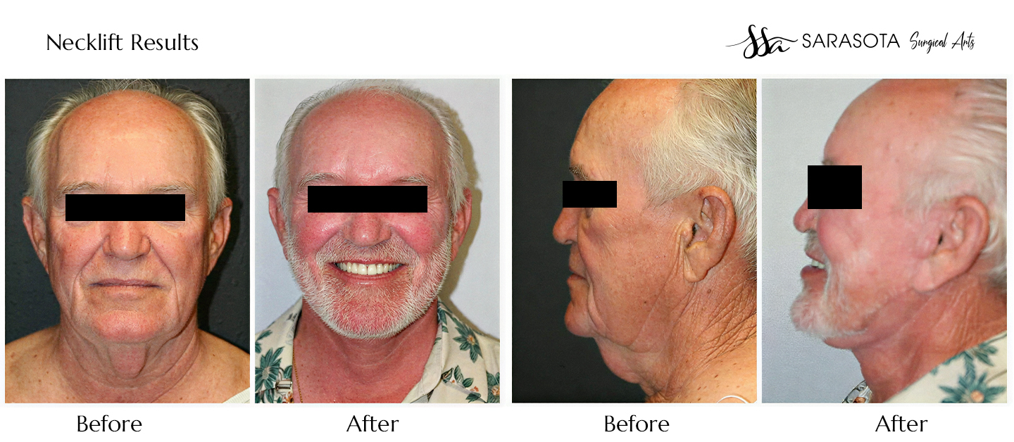 Who Does the Best Neck Lift in Florida?