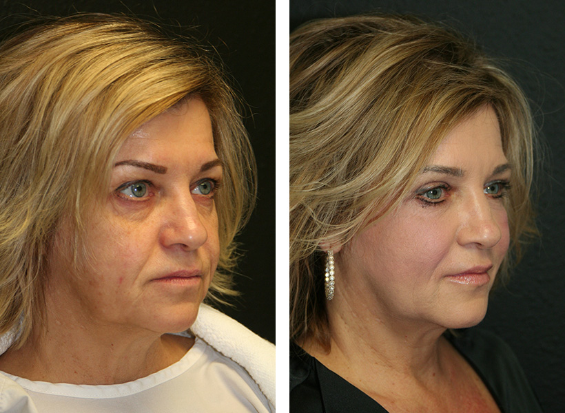 Who Does the Best Eyelid Surgery in Florida?