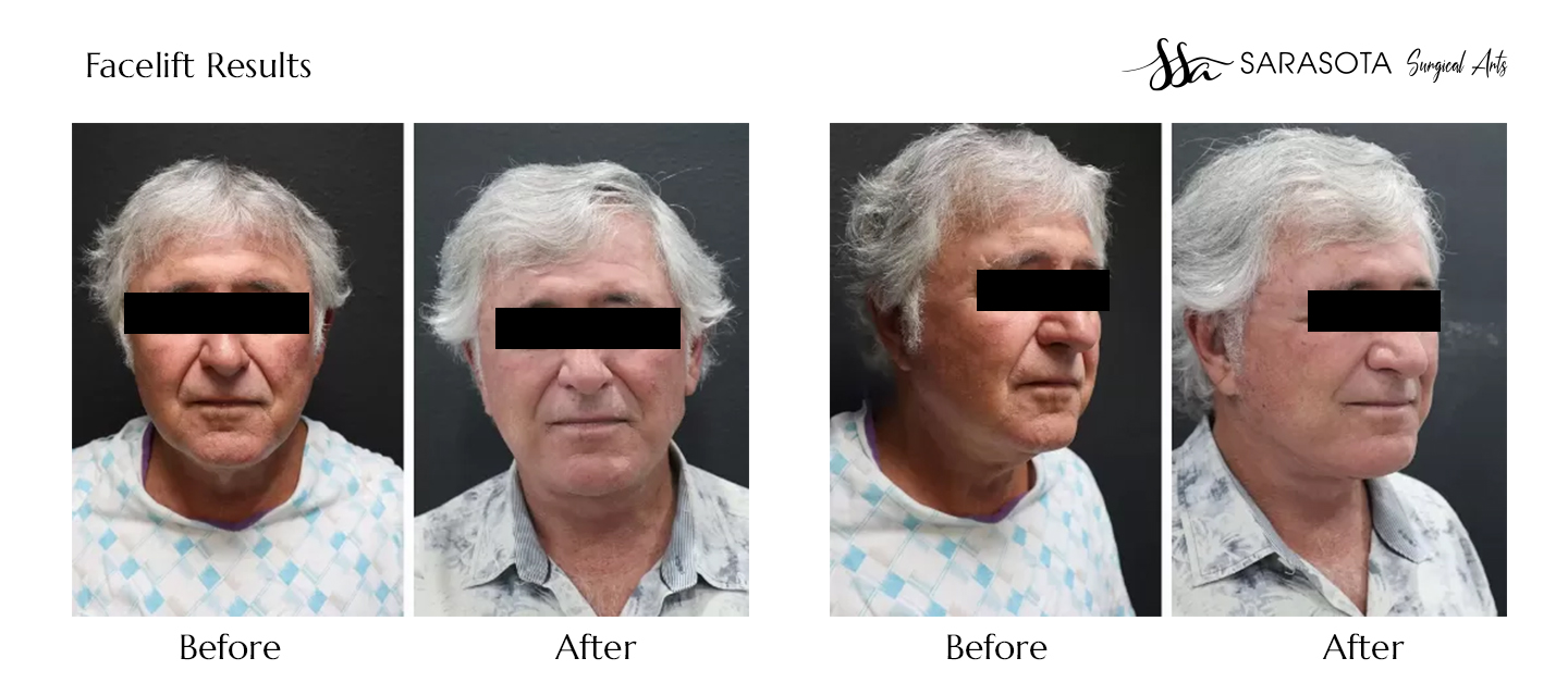 Who Does the Best Male Facelift Surgery in Sarasota?