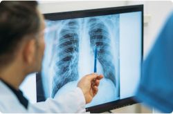 Lung Cancer Group on Secondary Asbestos Exposure: Why Family Members Are at Risk of Lung Cancer