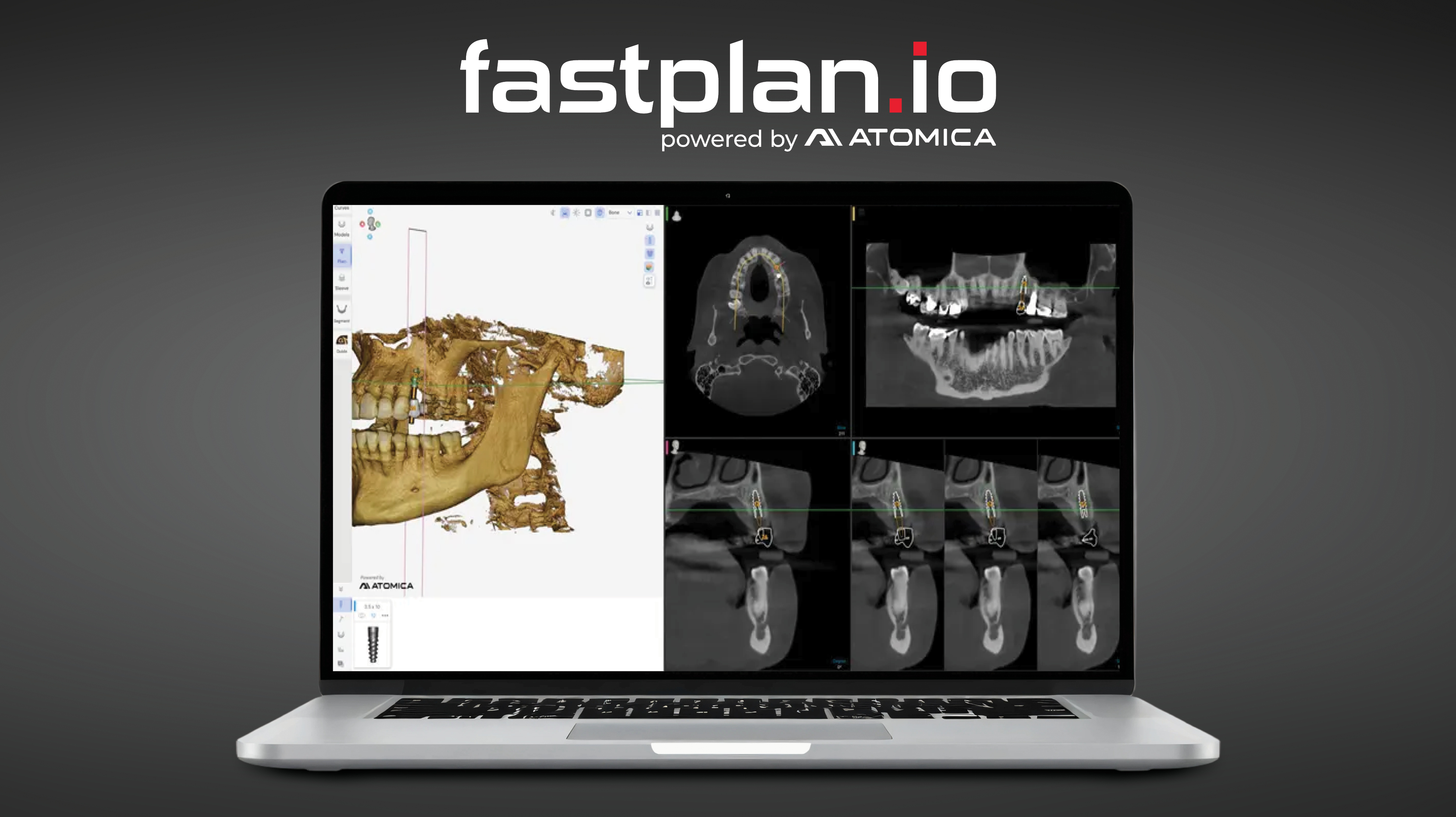 Glidewell Introduces fastplan.io(TM) Software for In-Office Guided Implant Planning and Surgical Design