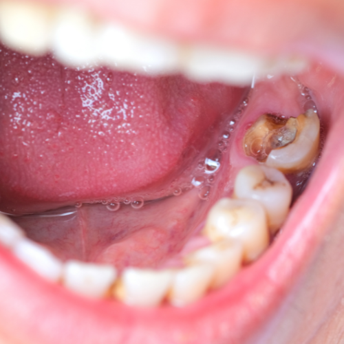 InjuryClaims.com Connects Suboxone Users to Legal Help for Tooth Decay