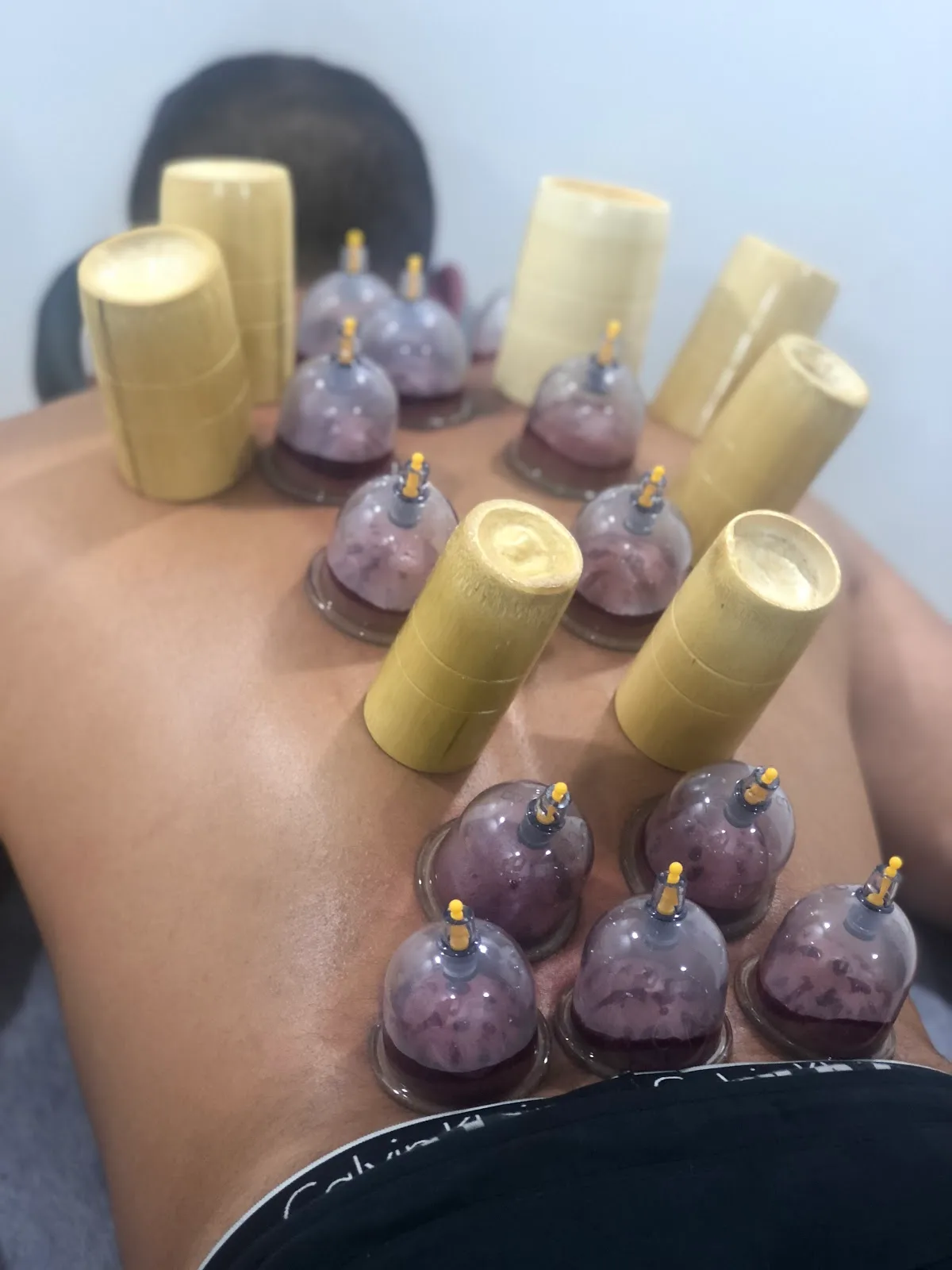 Cura Co Hijama Cupping Therapy - Photo 5