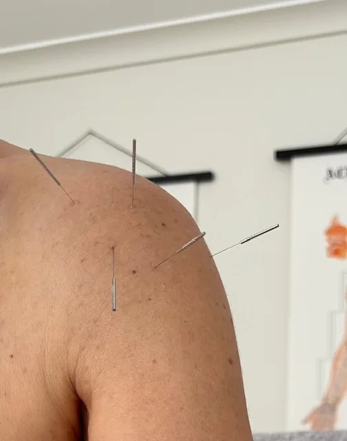 Spirit Level Acupuncture - Adelaide - Photo 4