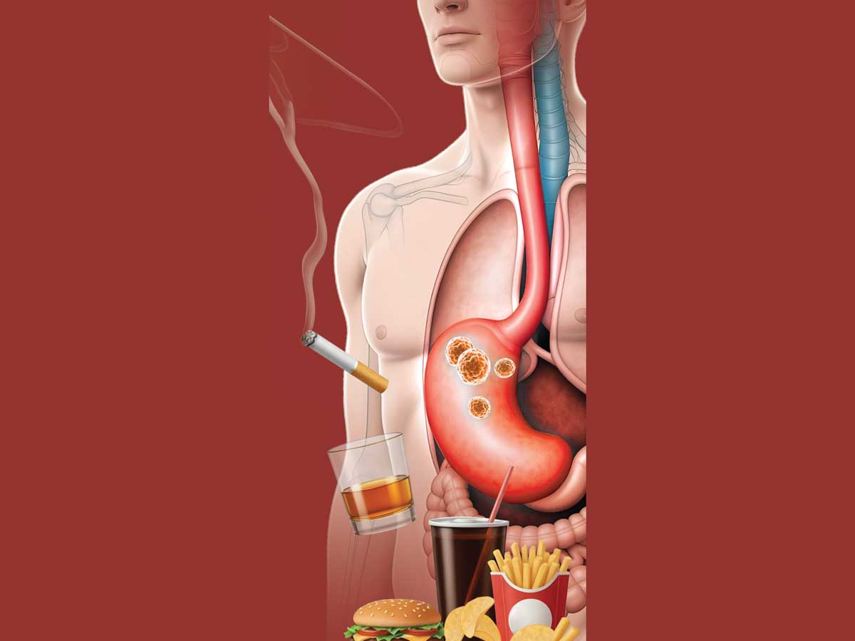 Diagnóstico tardío de cáncer de estómago en menores de 50 años, 80% confundido con gastritis.