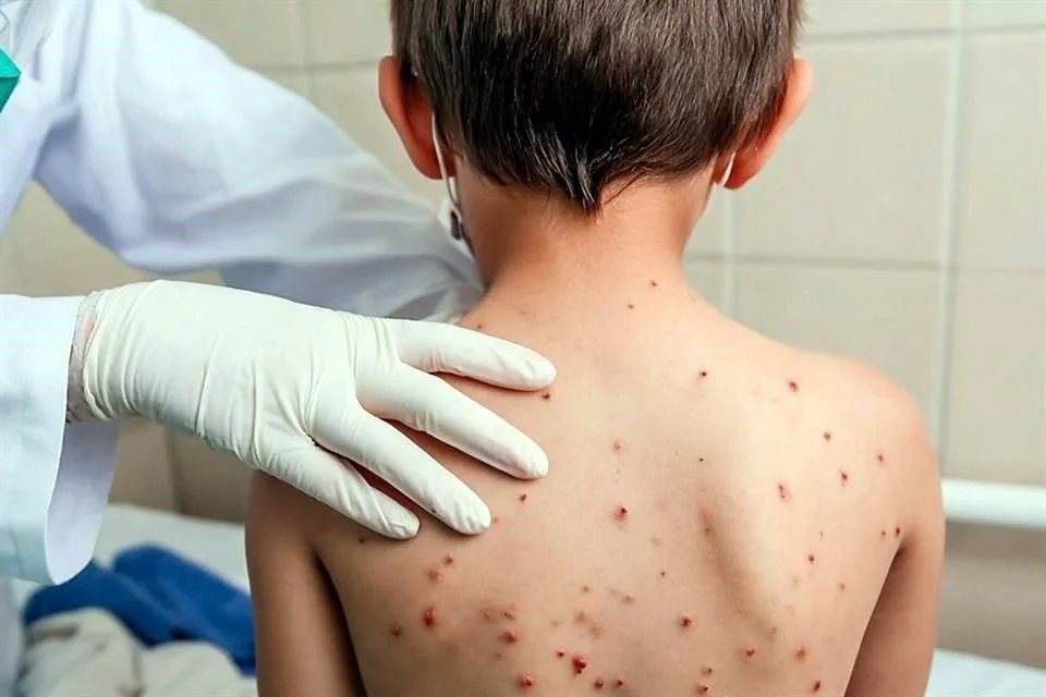 Se registran más de 6,000 casos de sarampión al año.