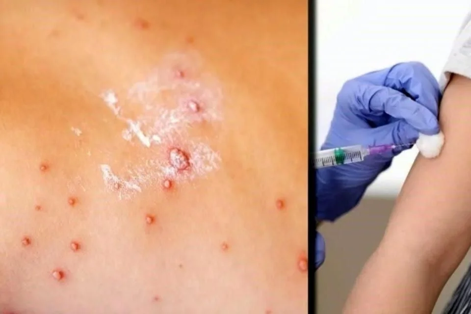 Fallece bebé en Tlaxcala por sarampión