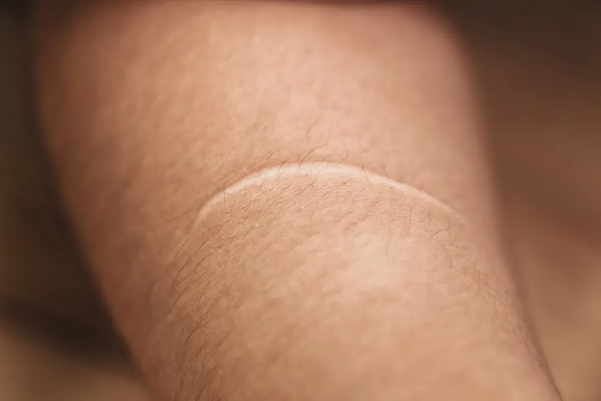 Scar on an arm