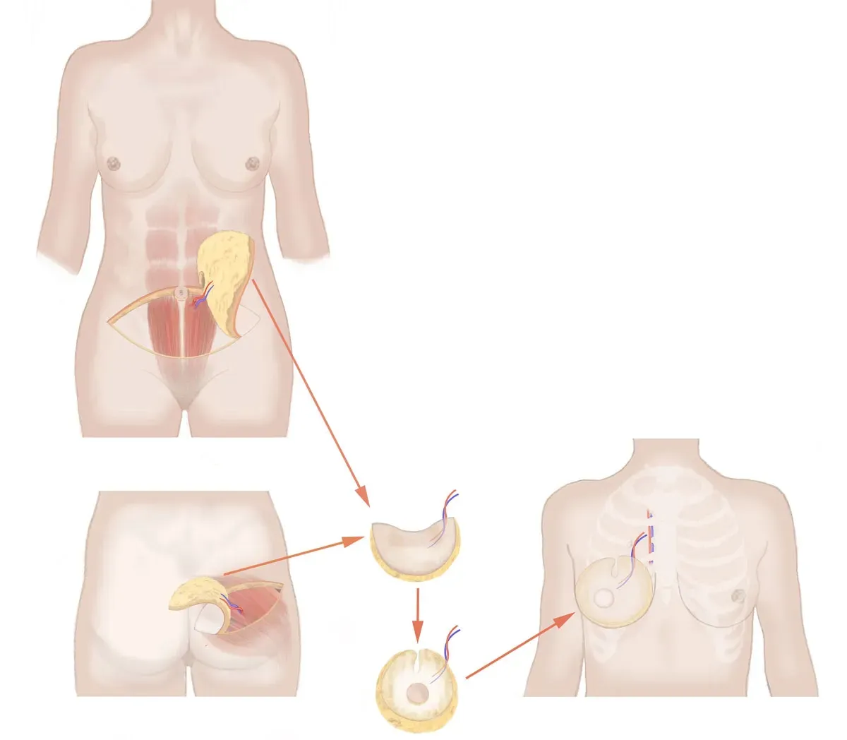Reconstruction of a breast reconstruction