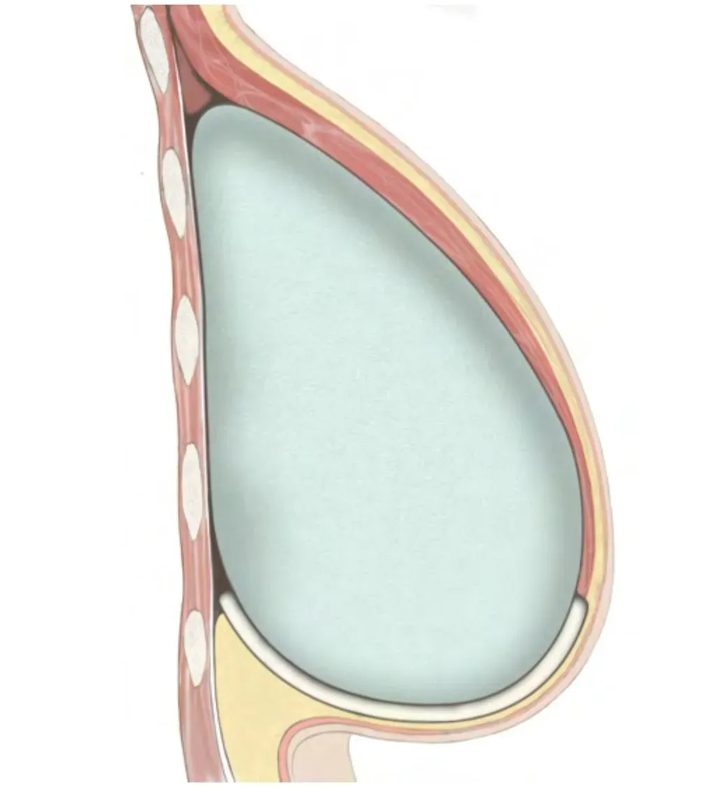 Representation of a breast with a breast implant