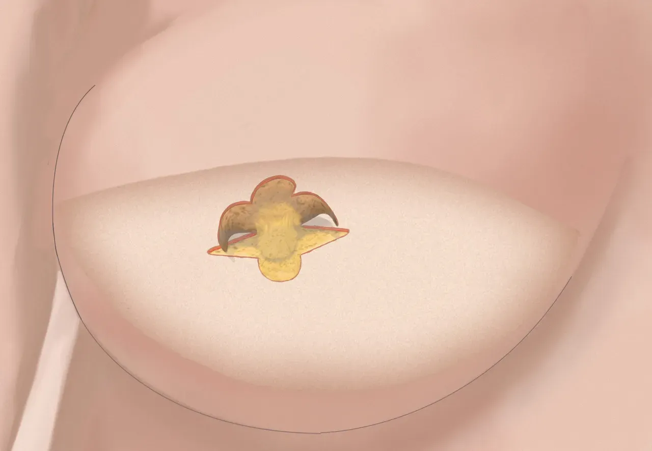 Representation of a breast during reconstructive surgery
