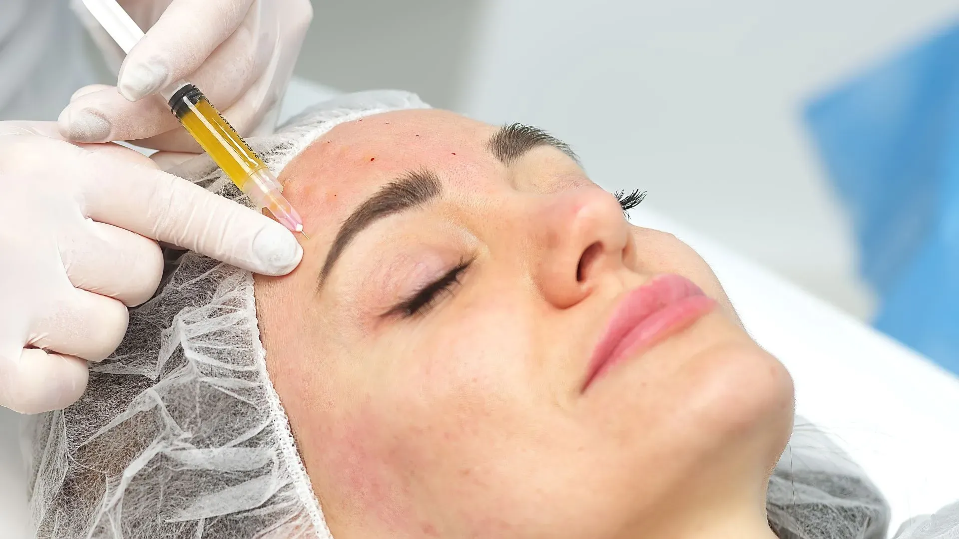 Woman is getting PRP injected into her forehead