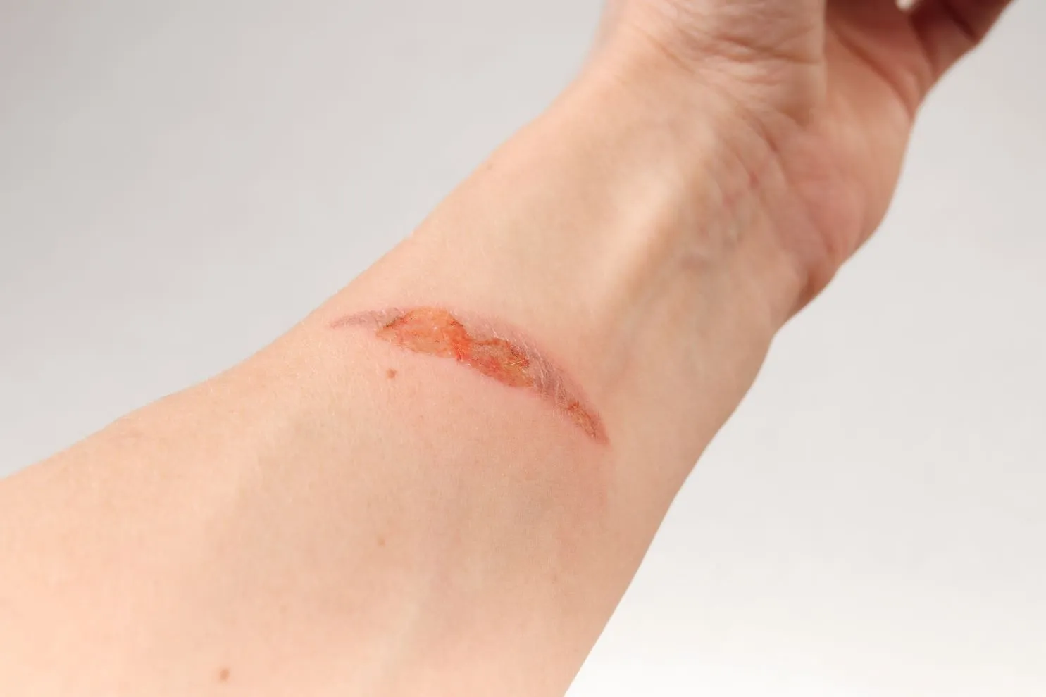 Unterarm mit einer Narbe