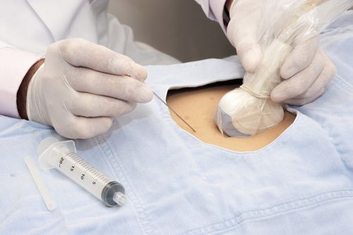 Médecin faisant une ponction
