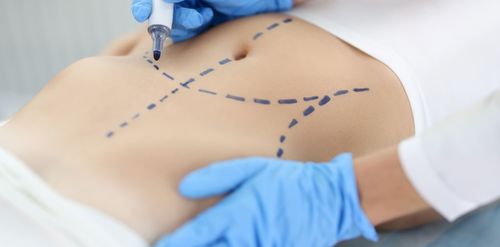 Liposucción