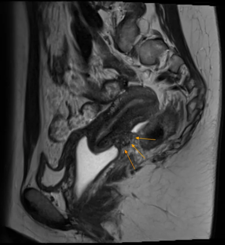 2023.03.28 Endometriose 2.webp