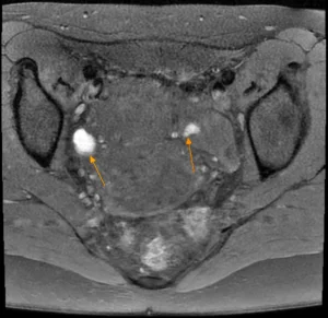 2023.03.28 Endometriose 5.webp