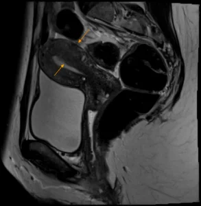 2023.03.28 Endométriose 7.webp