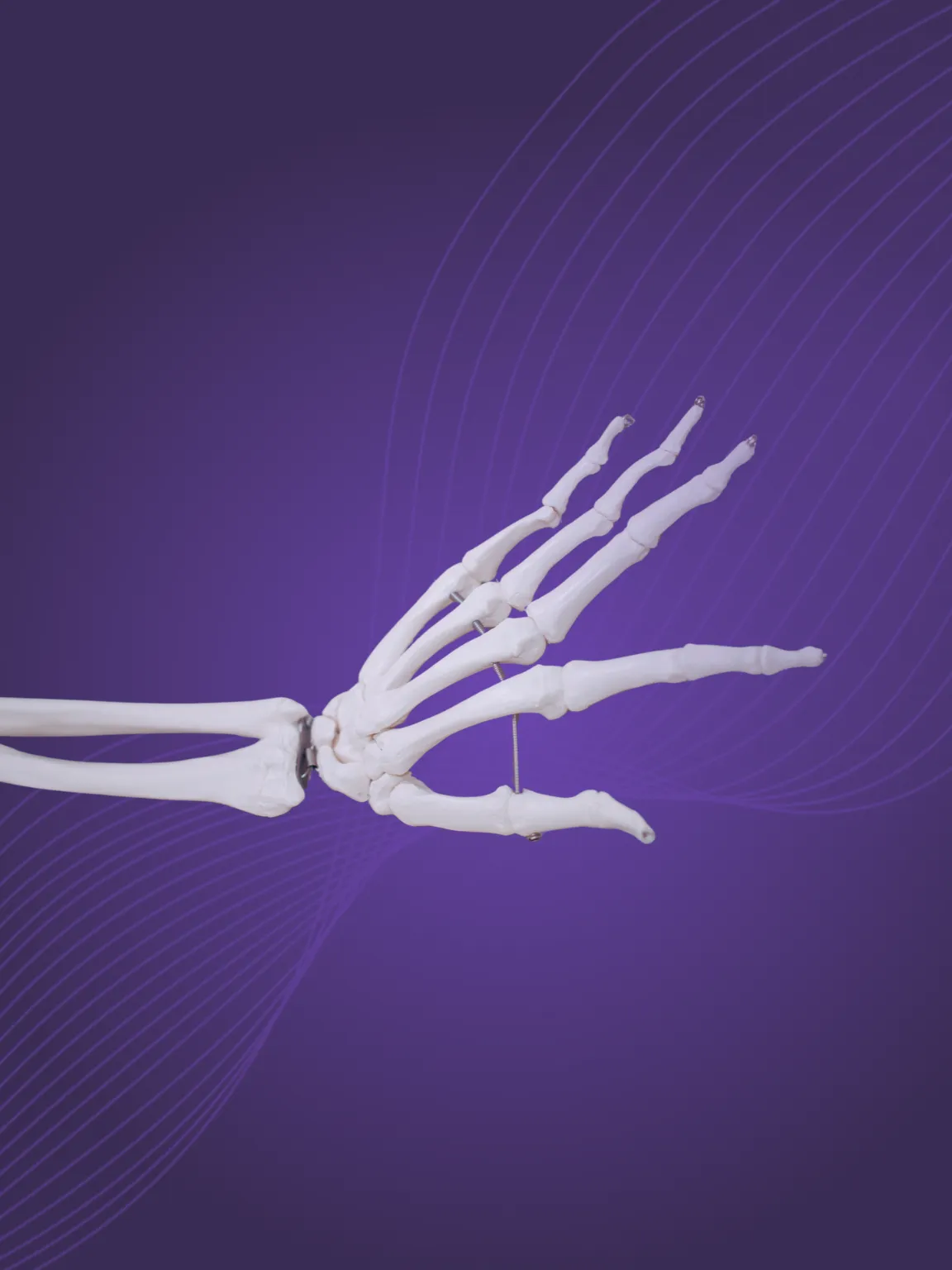 What is a sprained thumb?