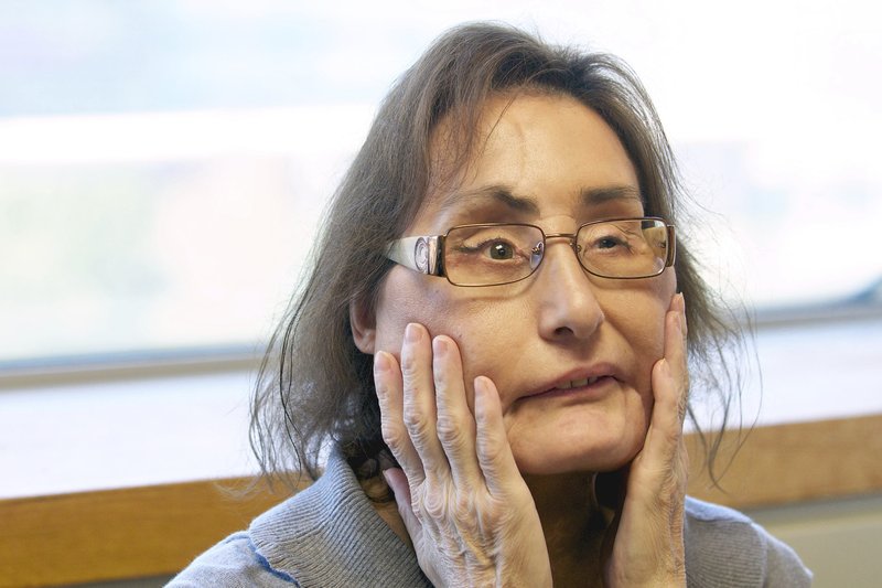 Connie Culp 1st Us Partial Face Transplant Recipient Dies