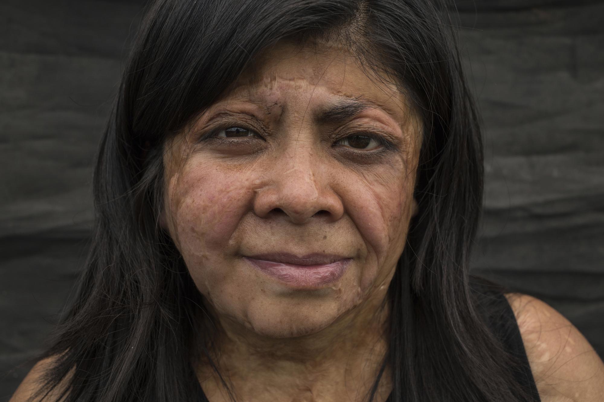 Elisa Xolalpa poses for a portrait during an interview recounting how she survived an acid attack while tied to a post by her ex-partner, damaging her face, chest, back, arms, hands, and making her lose her right finger, as she works at her greenhouse where grows plants to sell at a market in Mexico City, Saturday, June 12, 2021. The attack was 20 years ago when she was age 18, but he was arrested for the first time this year, facing a charge of domestic violence. (AP Photo/Ginnette Riquelme)