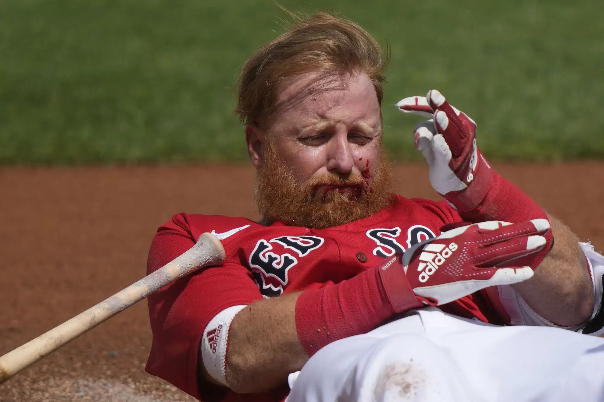 Red Sox infielder Justin Turner hit in face by pitch | AP News