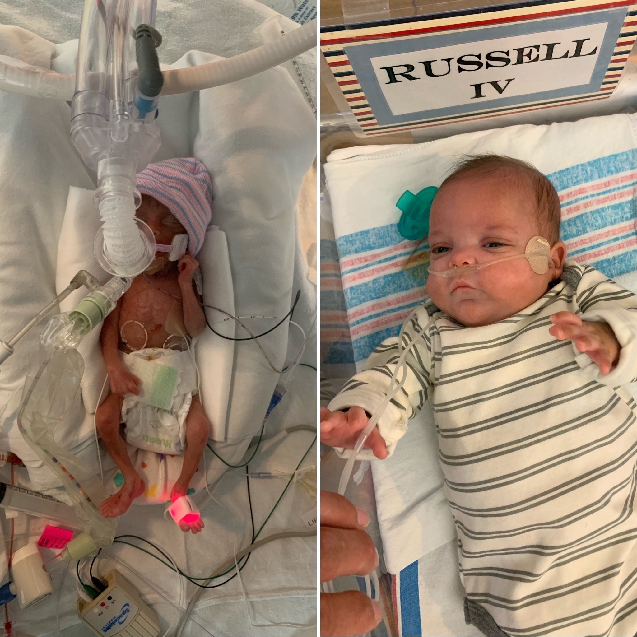 Boy Born After 22 Weeks In Womb Home After 19 Weeks In Nicu Ap News