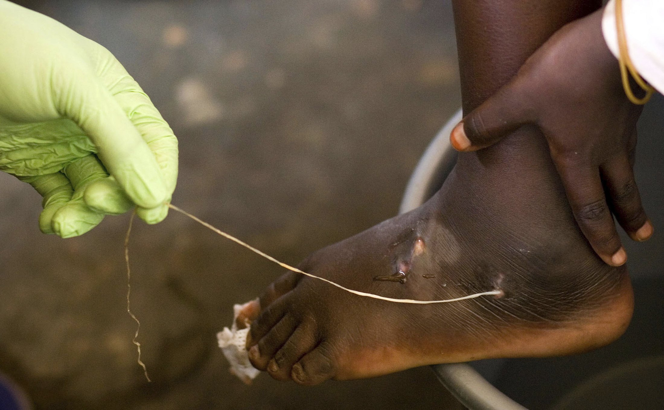 Guinea worm closer to extinction as cases halve within a year