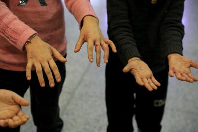 Niños migrantes iraquíes muestran a reporteros sus manos con heridas e infecciones a su llegada al aeropuerto en Irbil, Irak, el 26 de noviembre de 2021, tras un intento fallido de entrar a la Unión Europea. (AP Foto.Hussein Ibrahim)