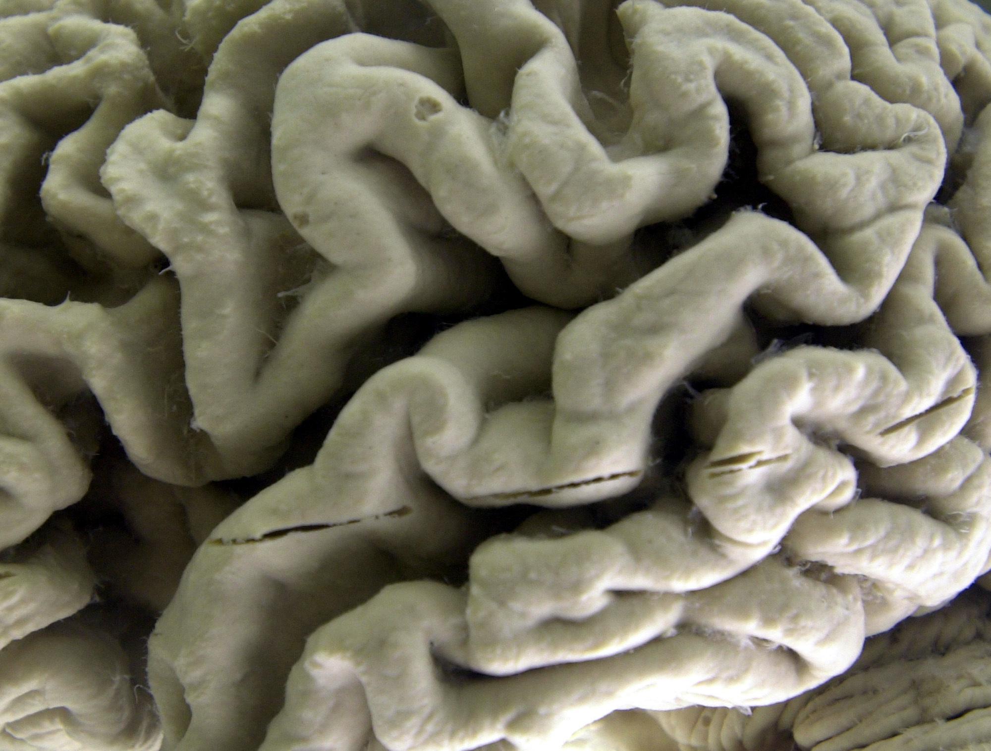 Drug slows Alzheimer's but can it make a real difference? - The Associated Press - en Español