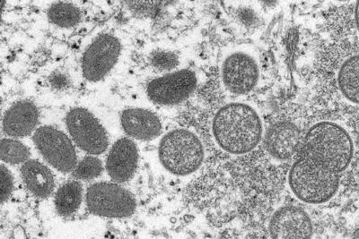 En esta imagen de 2003 de un microscopio de electrones difundida por los Centros para el Control y la Prevención de Enfermedades de Estados Unidos, se ven viriones maduros y en forma de óvalo de la viruela símica, a la izquierda, y viriones inmaduros con forma esférica, a la derecha, obtenidos de una muestra de piel humana relacionada con el brote de perritos de las praderas de 2003. (Cynthia S. Goldsmith, Russell Regner/CDC via AP, Archivo)