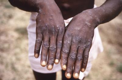 ARCHIVO - La foto de 1997 provista por los CDC durante una investigación de un brote de viruela símica en la República Democrático del Congo muestra el sarpullido característico de la enfermedad en el dorso de las manos de un paciente. (CDC via AP, File)