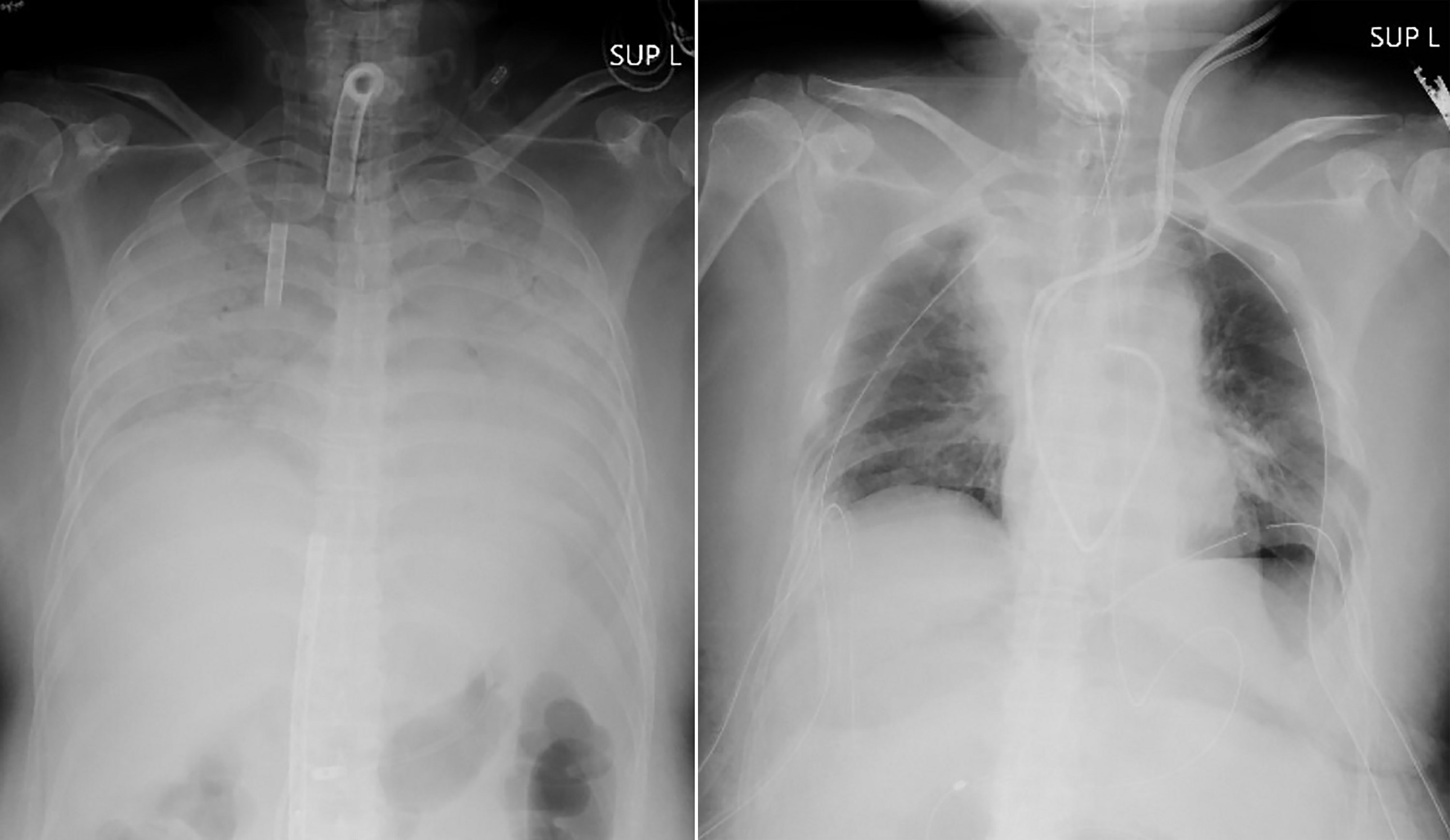 grade 2 mesothelioma