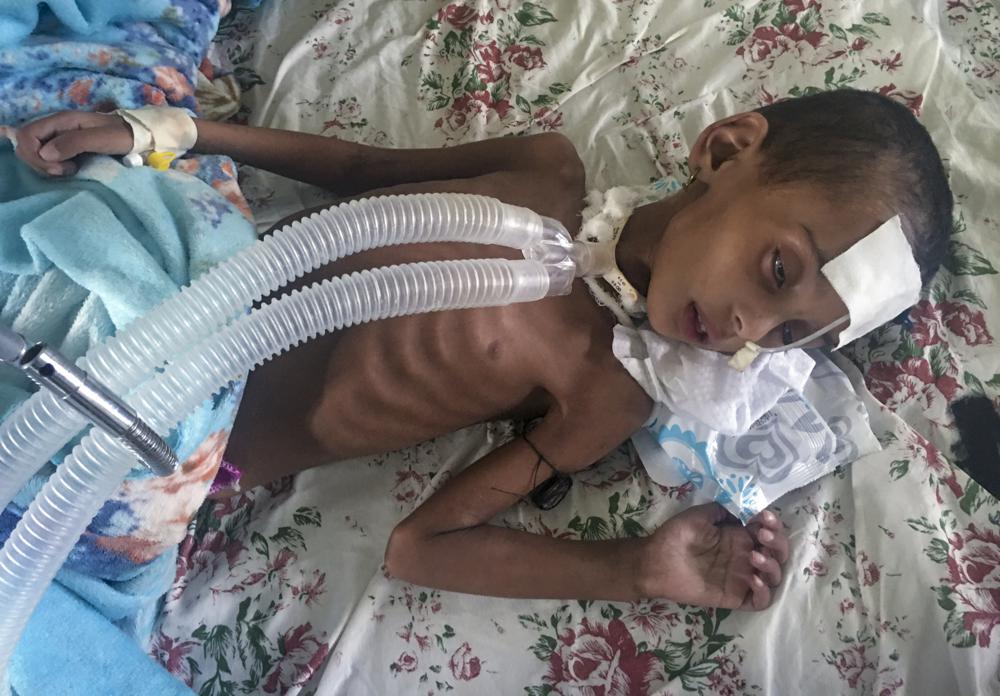 In this photo provided anonymously, Rahwa Mehari, 4, who first suffered from malnutrition according to her father and medical records show then developed a cerebral tuberculoma, is treated at the Ayder Referral Hospital in Mekele, in the Tigray region of northern Ethiopia, Monday, Oct. 4, 2021. Her father Mehari Tesfa, from the Kilte Awulaelo district, says he has not been able to farm or feed his family since Eritrean troops stole his water pump and generator during the war. (AP Photo)