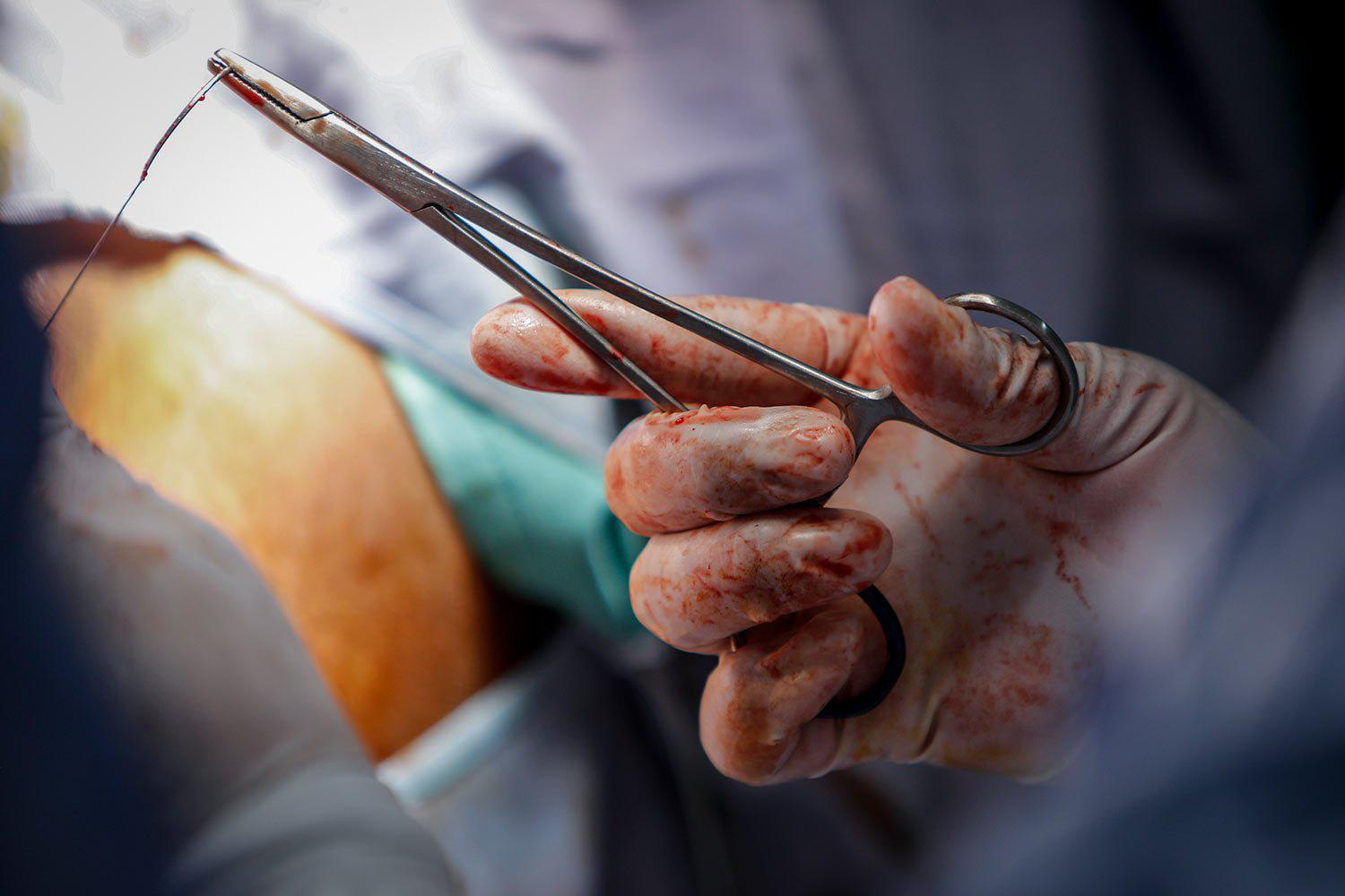 Doctors perform a repair surgery on a fistula patient who had previously undergone female genital mutilation (FGM), at the Edna Adan Maternity Hospital in Hargeisa, Somaliland Tuesday, Feb. 8, 2022. (AP Photo/Brian Inganga)