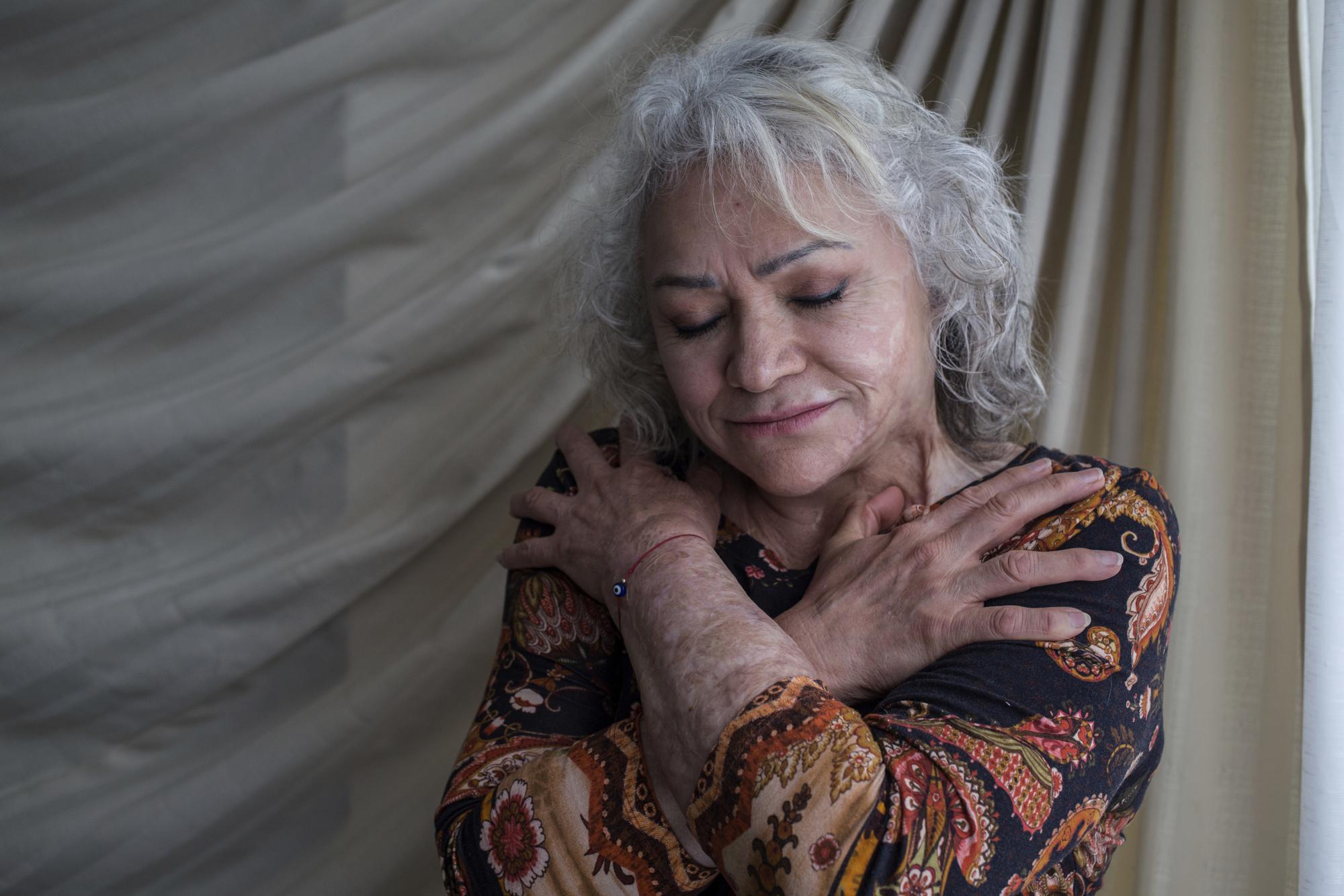 Martha Avila, who survived an acid attack by her former son-in-law four years ago when she was 59, embraces herself as she poses for a portrait at her home in the state of Mexico, Mexico, June 13, 2021. Avila’s attack happened on International Women’s Day in 2017 while she was at work, two years after her daughter had left her partner and was in hiding from him, burning her hands, face, neck and chest. The attack came after two incidents when he had thrown acid on the family car outside their home. After 15 surgeries, she expects to undergo more to help regain mobility. (AP Photo/Ginnette Riquelme)
